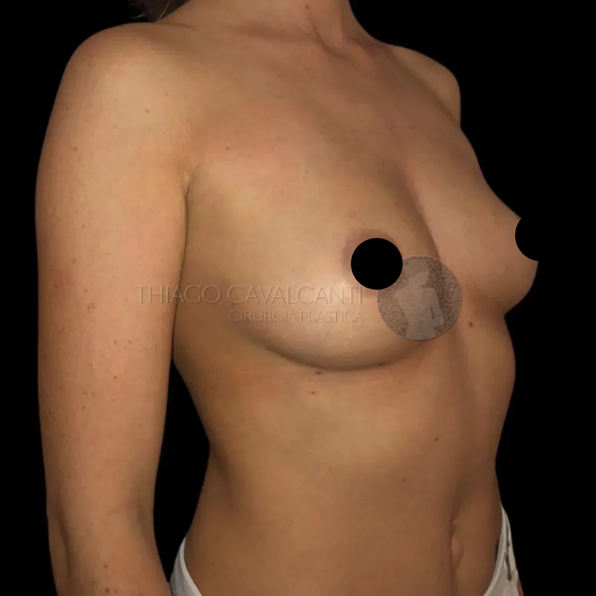Prótese de Silicone R24R - antes