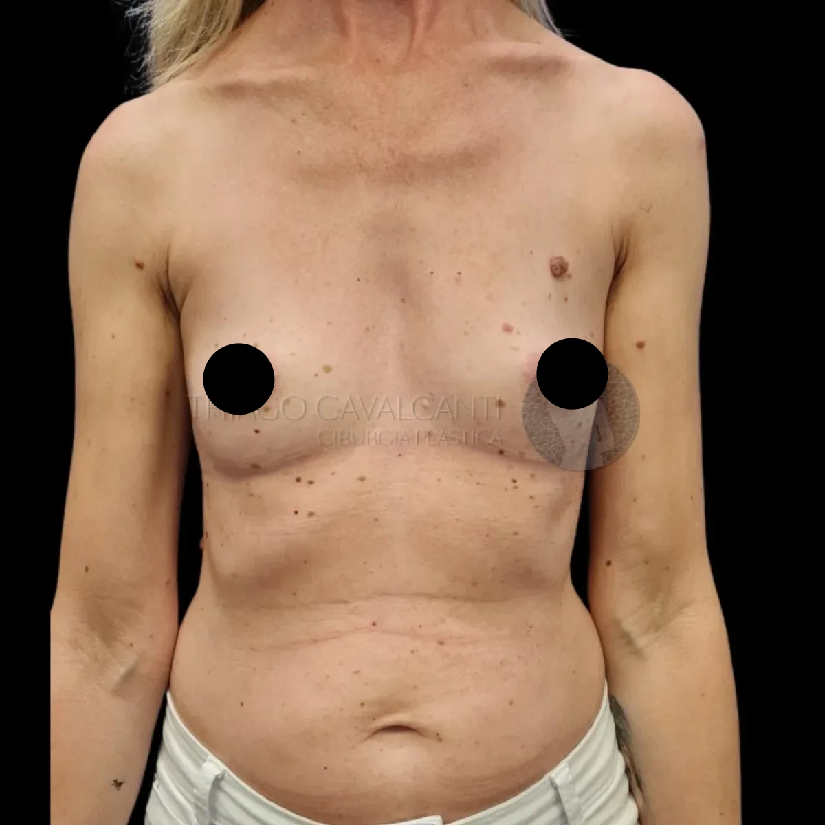Prótese de Silicone R24R - antes