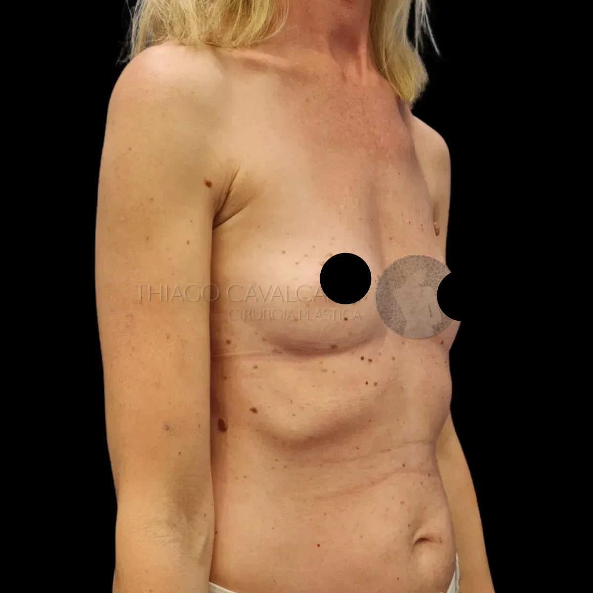 Prótese de Silicone R24R - antes