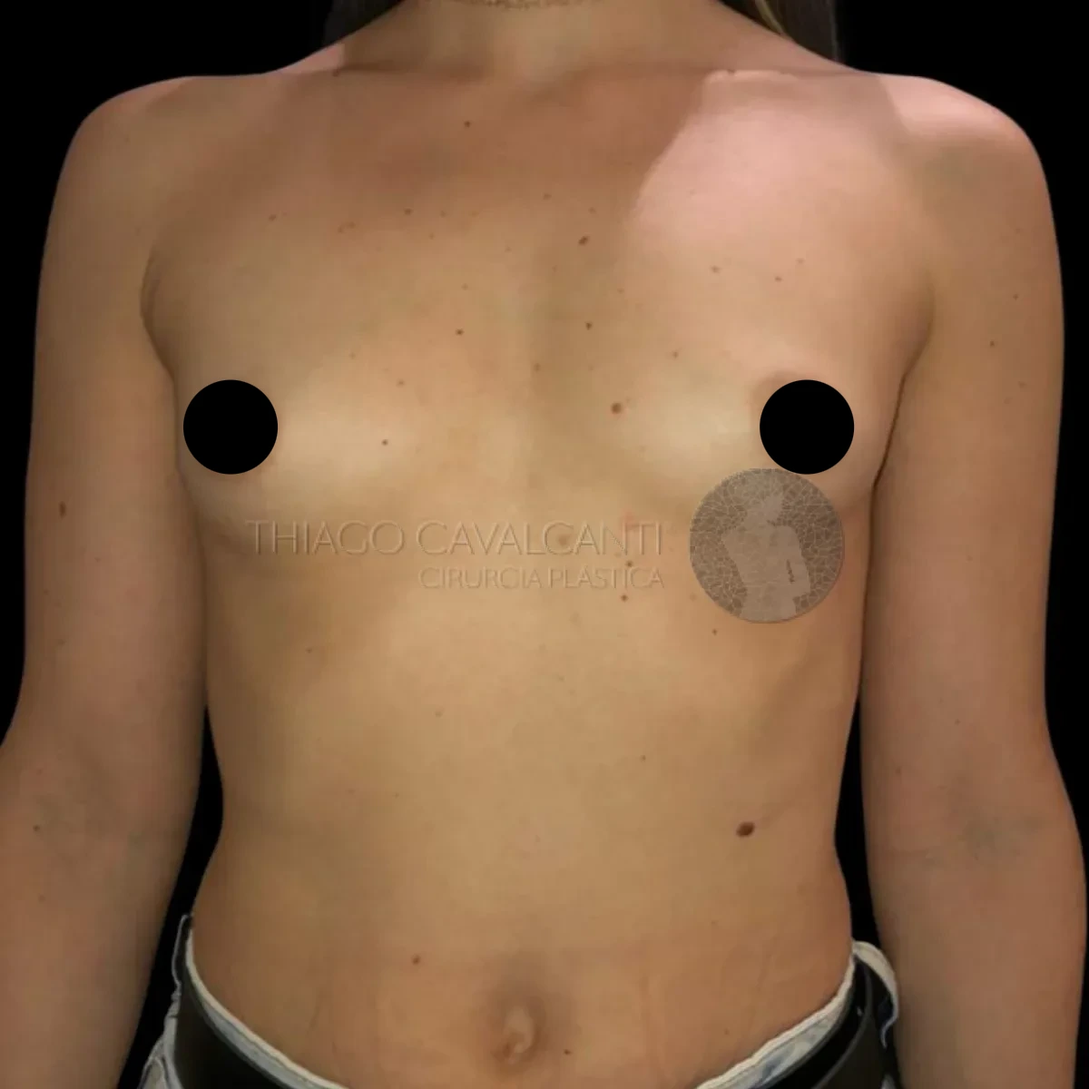 Prótese de Silicone R24R - antes