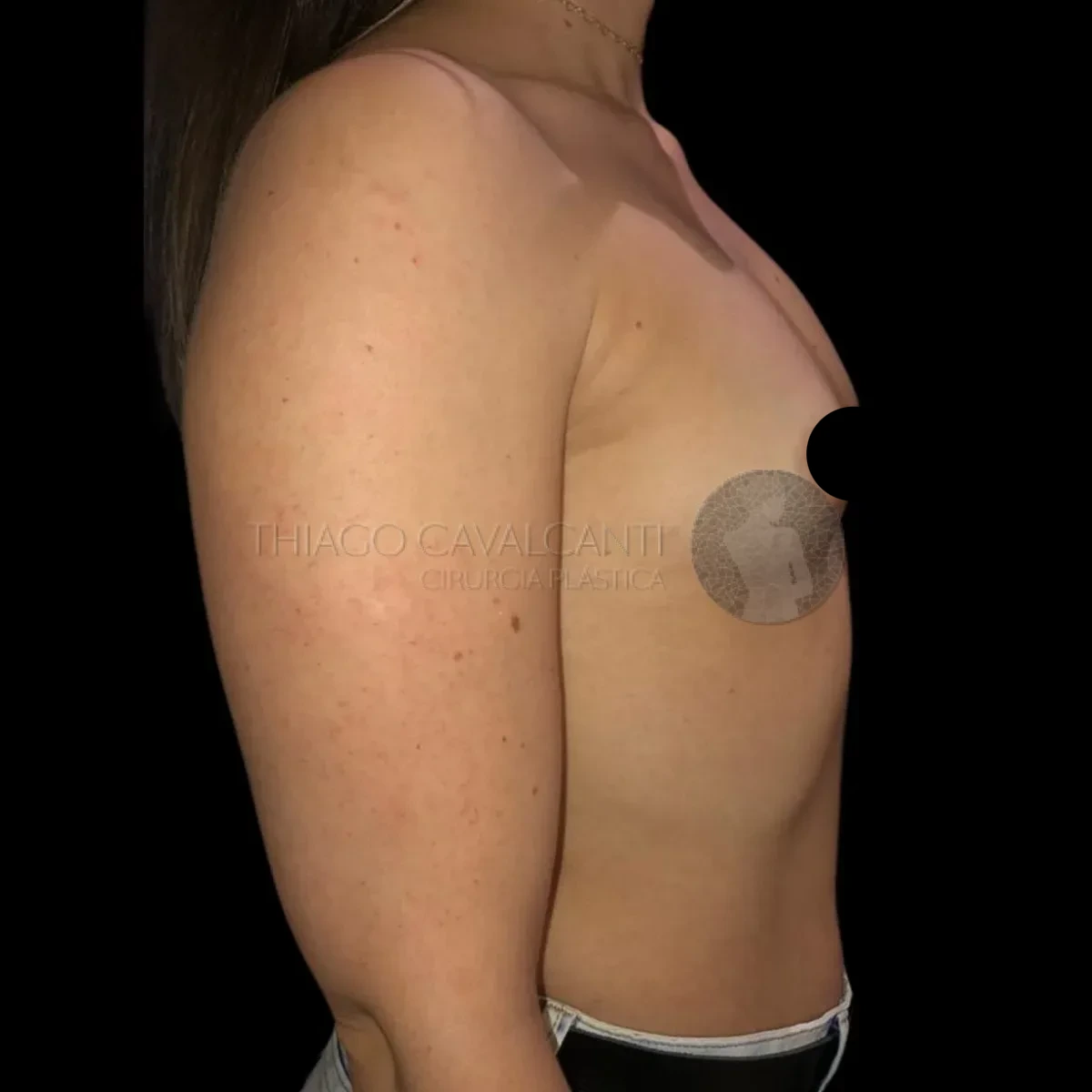 Prótese de Silicone R24R - antes