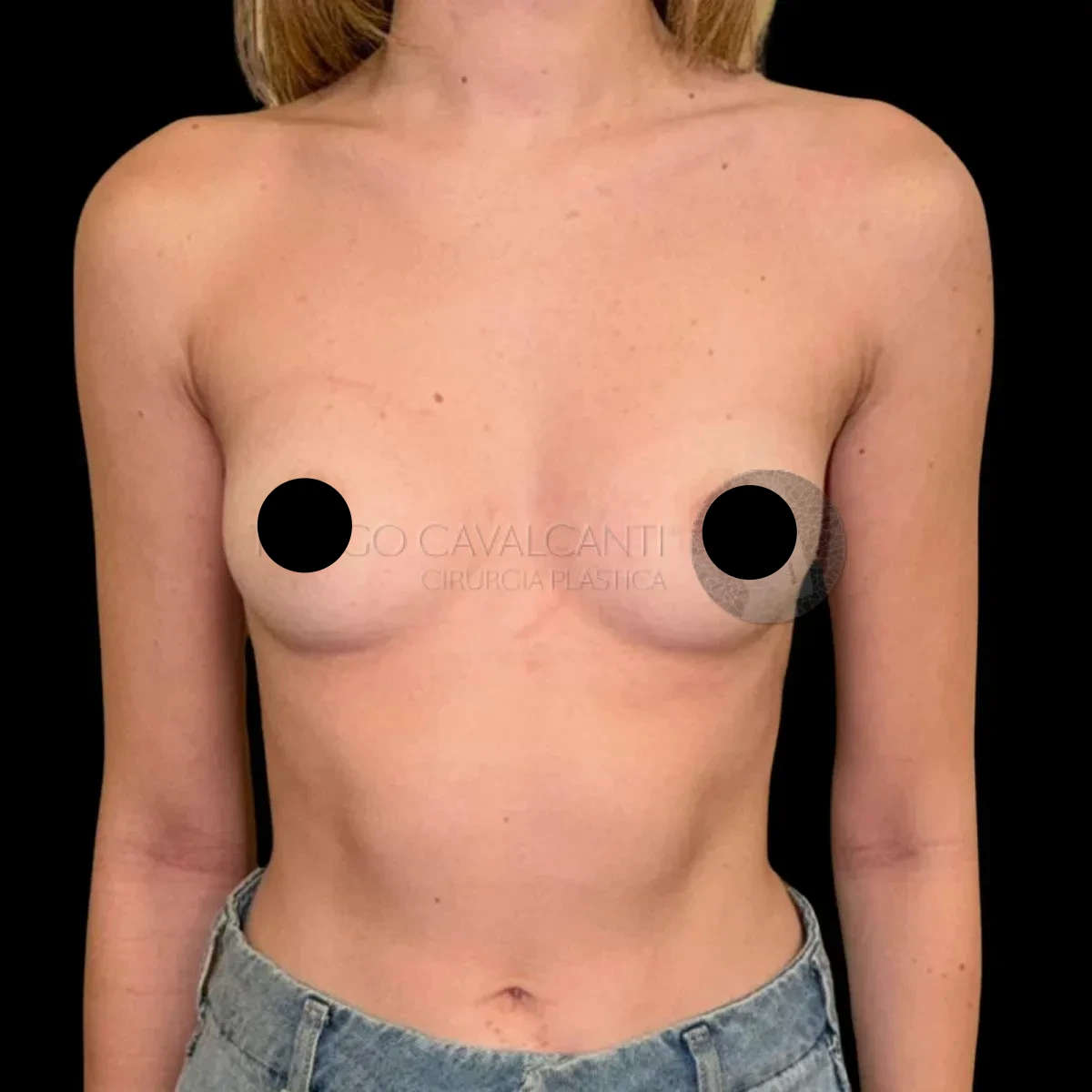Prótese de Silicone R24R - antes