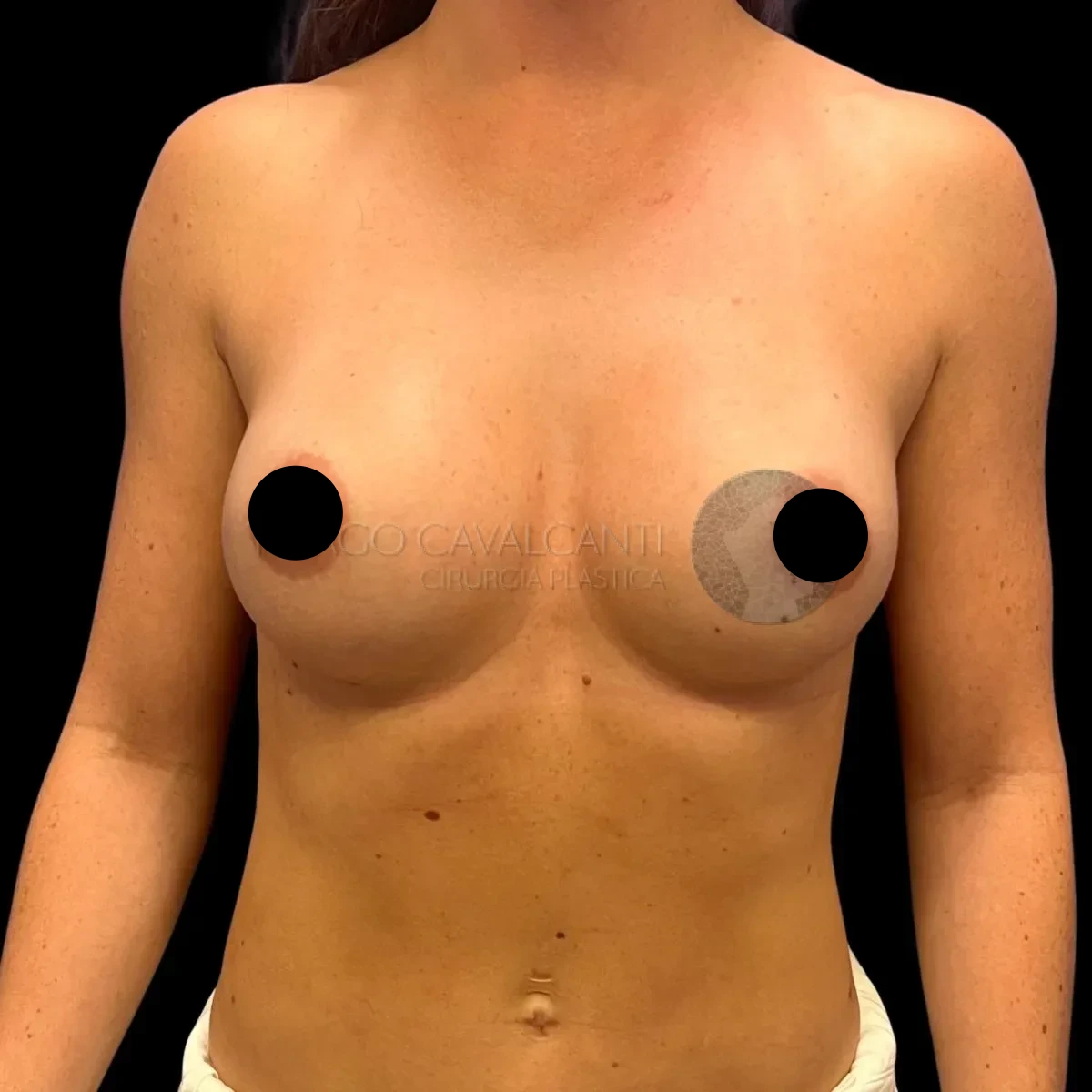 Prótese de Silicone R24R - depois