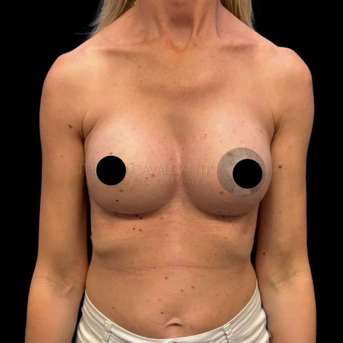 Prótese de Silicone R24R - depois